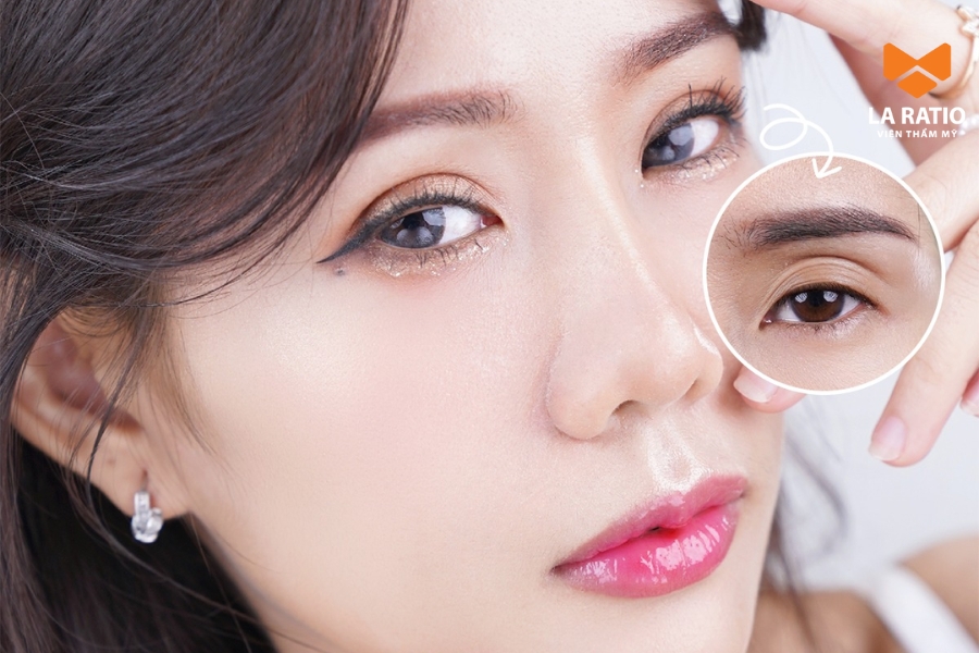 Cắt mí bao nhiêu tiền? Giá cắt mí dao động từ 7 - 30 triệu