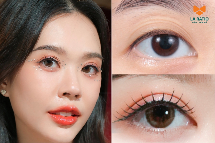 Cắt mí mấy tháng thì đẹp? Thông thường là sau 1 - 3 tháng