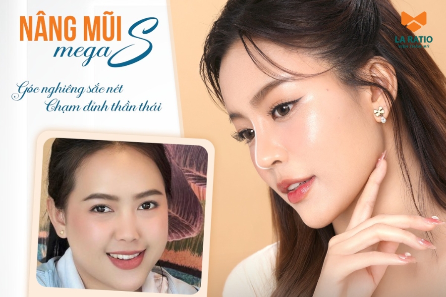 Nâng mũi không băng nẹp - Chỉ 1 tiếng là đẹp, giúp khách hàng sở hữu dáng mũi hài hòa