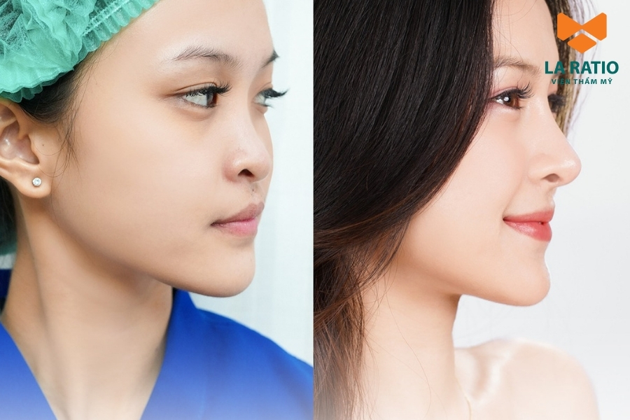 Chị đẹp thay đổi góc nghiêng, bật thần thái nhờ bàn tay vàng của bác sĩ Võ Thành Trung Chị đẹp thay đổi góc nghiêng, bật thần thái nhờ bàn tay vàng của bác sĩ Võ Thành Trung