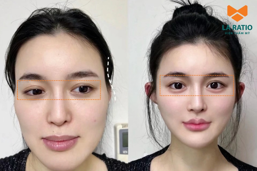 Cắt mắt Trung Hoa mang dấu ấn sắc sảo nhưng vẫn giữ nét mềm mại đặc trưng Á Đông. Cắt mắt Trung Hoa mang dấu ấn sắc sảo nhưng vẫn giữ nét mềm mại đặc trưng Á Đông.