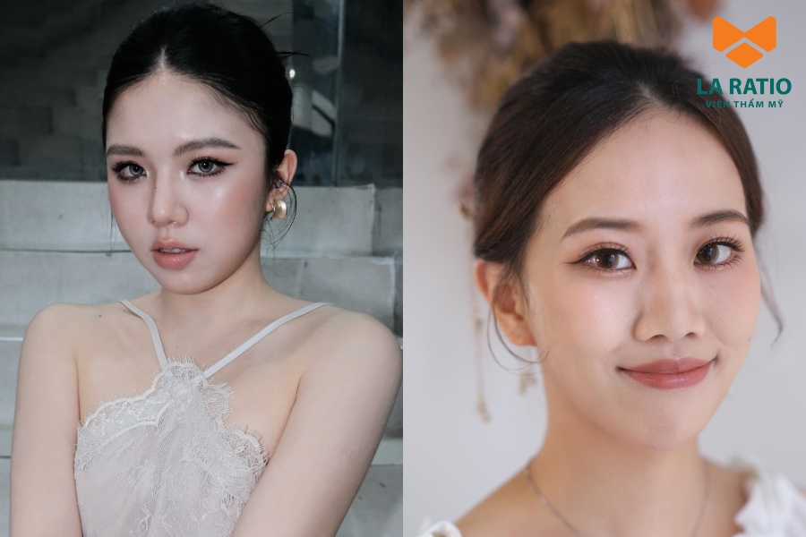 Bạn nên thăm khám với bác sĩ để quyết định có nên cắt mắt Trung Hoa không Bạn nên thăm khám với bác sĩ để quyết định có nên cắt mắt Trung Hoa không