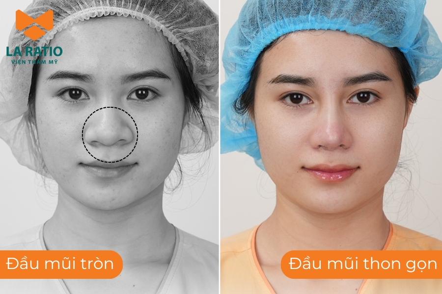 Tướng đầu mũi tròn có phần chóp mũi đầy đặn, tròn mềm hơn so với bình thường