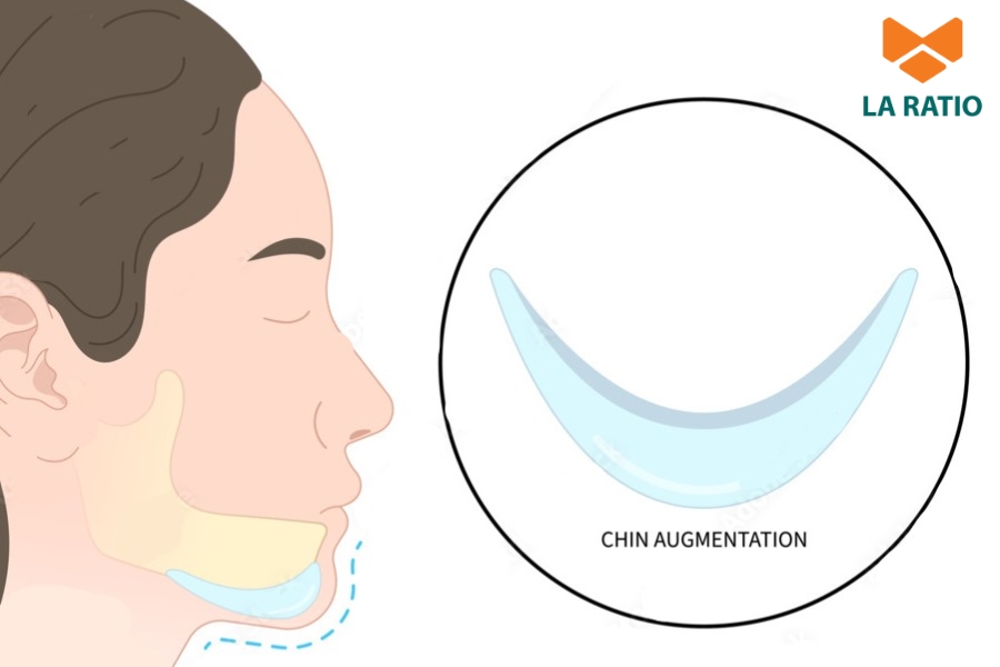Độn cằm phù hợp với những trường hợp cằm có ít khuyết điểm Độn cằm phù hợp với những trường hợp cằm có ít khuyết điểm