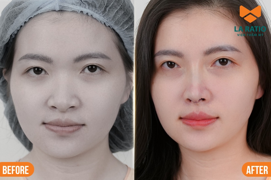 Nâng mũi S-Line giúp gương mặt vuông của nữ giới trở nên thanh thoát và mềm mại hơn Nâng mũi S-Line giúp gương mặt vuông của nữ giới trở nên thanh thoát và mềm mại hơn