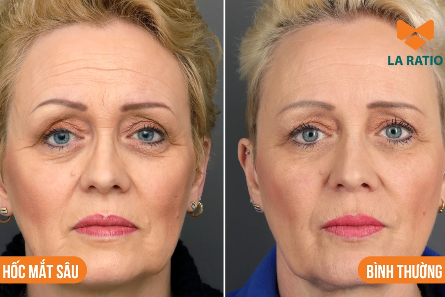 Hốc mắt sâu là tình trạng phần mắt bị trũng sâu hơn so với bình thường