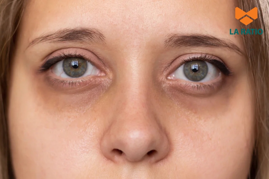 Phần lớn nguyên nhân khiến mắt bị cắt quá sâu là do tay nghề bác sĩ