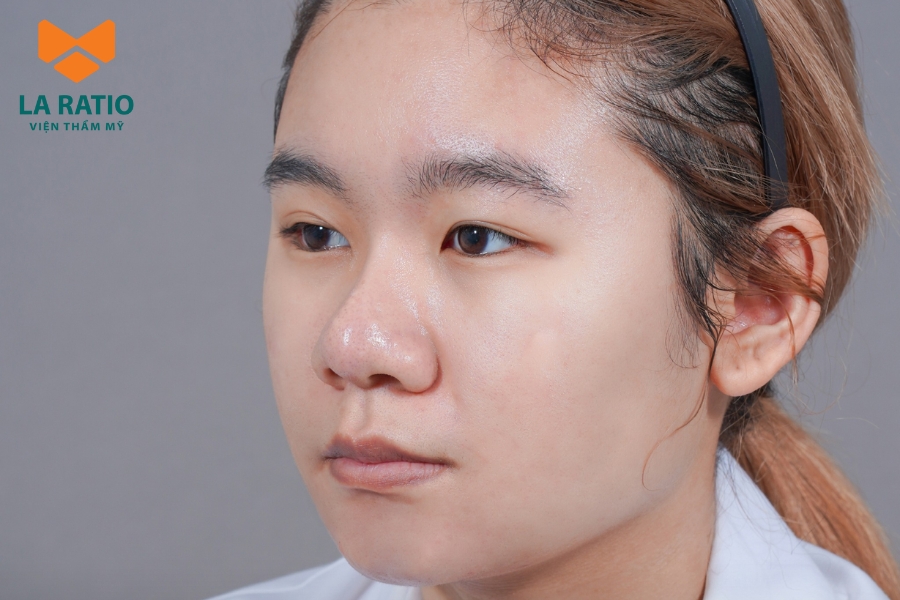 Phần lớn đầu mũi to tròn là do yếu tố di truyền từ ba mẹ hoặc ông bà trong gia đình