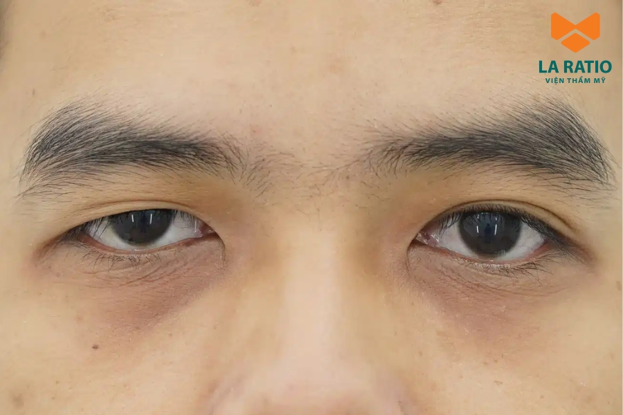 Nếu bạn đang gặp tình trạng hai bên mắt không cân xứng, có thể thực hiện chỉnh sửa