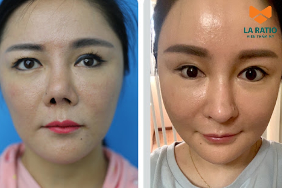 ù mang lại hiệu quả thẩm mỹ cao, cắt mí Trung Hoa vẫn tiềm ẩn một số biến chứng ù mang lại hiệu quả thẩm mỹ cao, cắt mí Trung Hoa vẫn tiềm ẩn một số biến chứng