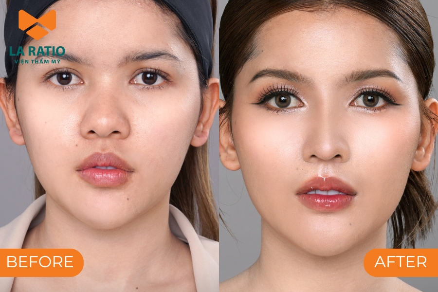 Thu nhỏ đầu mũi là phương pháp sửa đầu mũi tròn hiệu quả