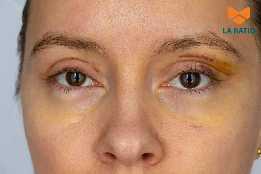 Cắt mí bị sâu là tình trạng nếp mí sau phẫu thuật được tạo quá cao, khiến mắt bị lõm vào