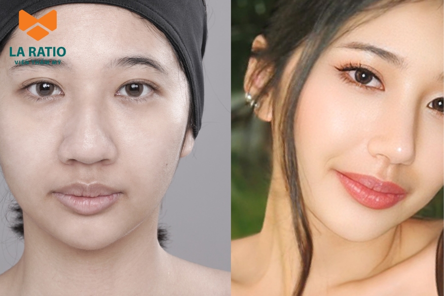 Đầu mũi to tròn khiến tổng thể gương mặt mất cân đối